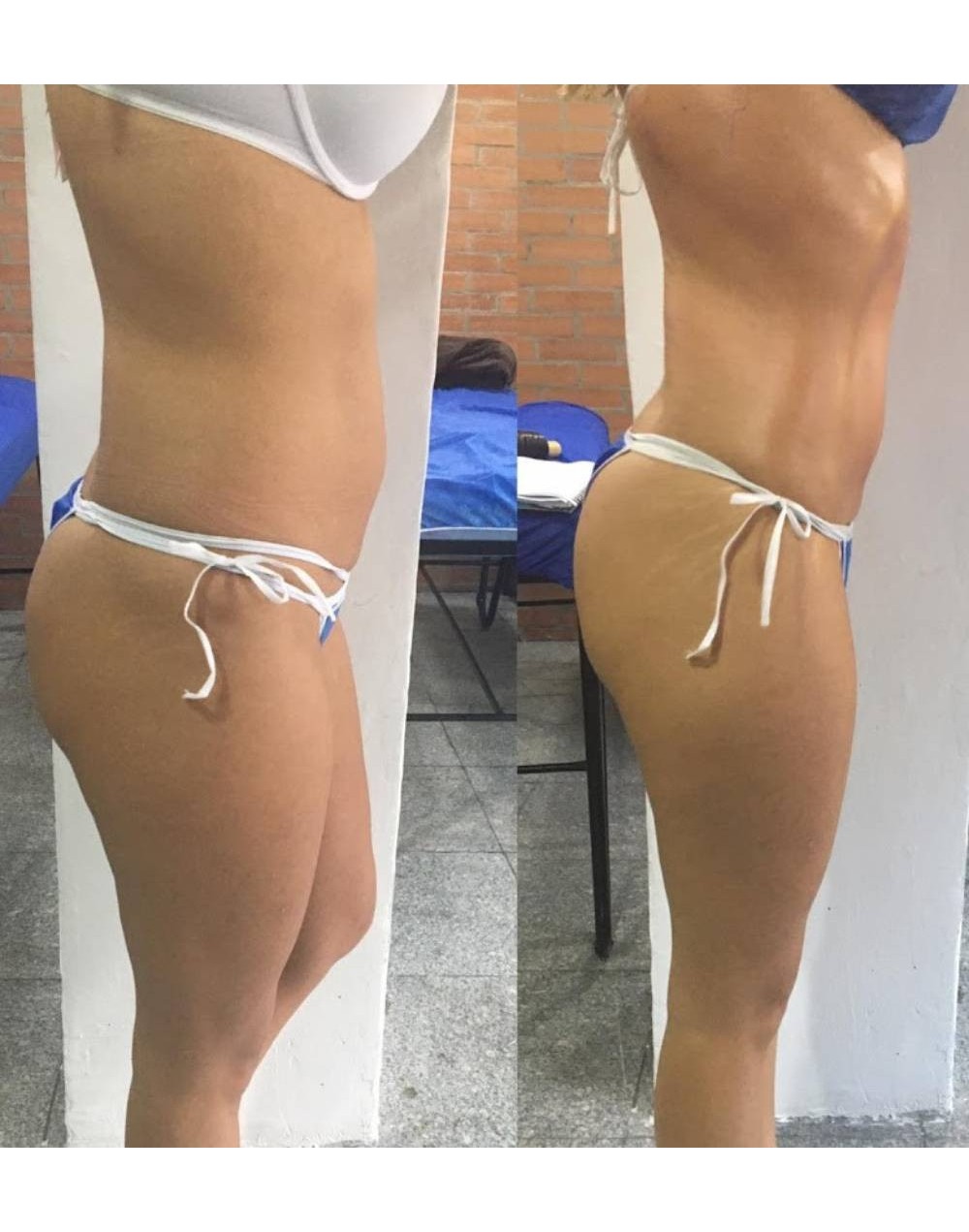 HIDROLIPOCLASIA