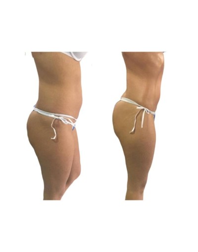 HIDROLIPOCLASIA