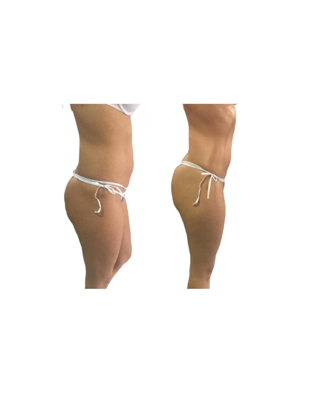 HIDROLIPOCLASIA