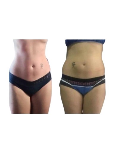 Intralipoterapia con microcanula soft model