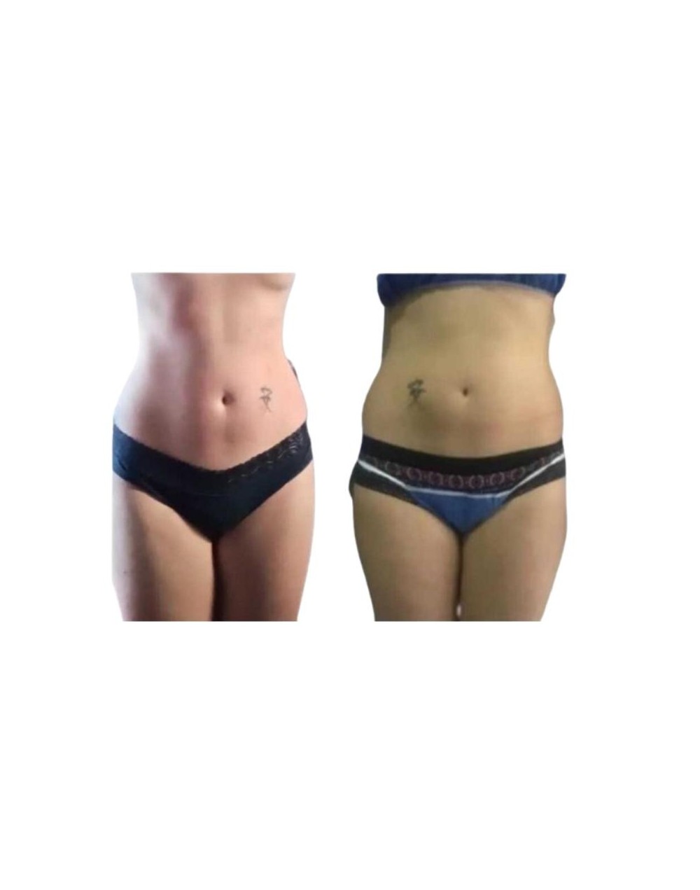 Intralipoterapia con microcanula soft model